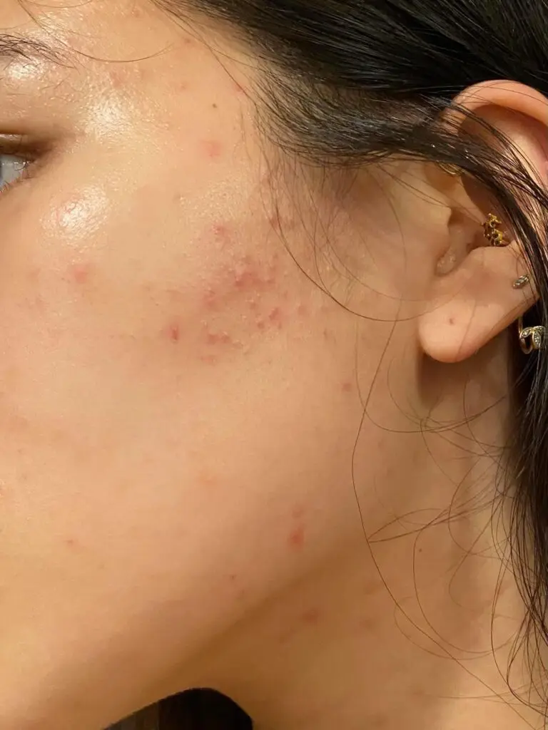 acne-autunnale-foto
