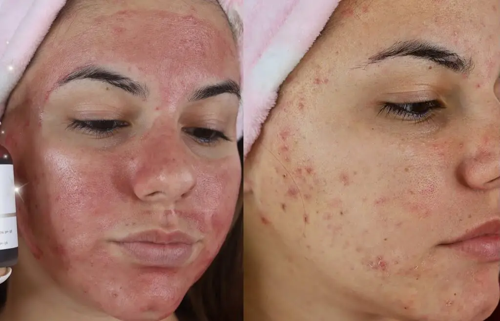 peeling-al-viso-acne