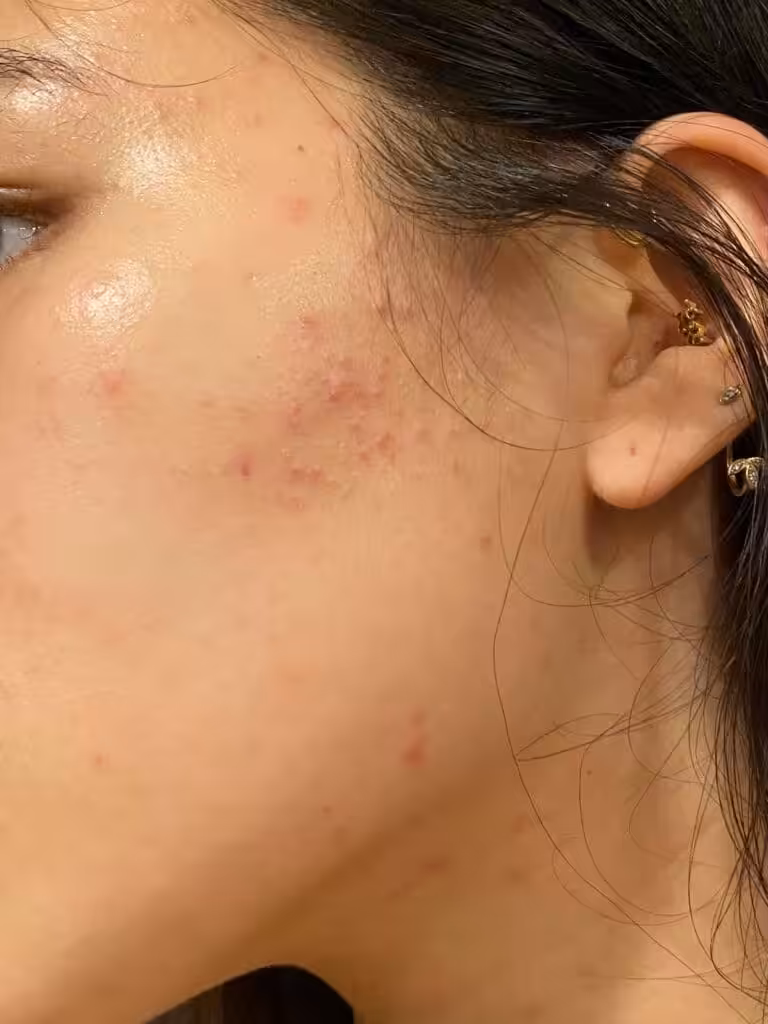acne-autunnale-foto